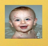 Bebeklerde Su Çiçeği Belirtileri ve Tedavisi