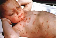 Gözde Su Çiçeği Belirtileri ve Tedavisi